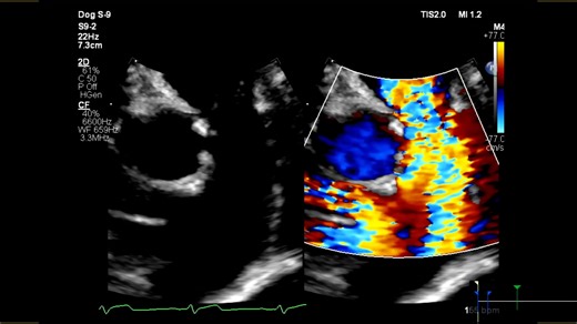 7.1K views | Above is a video of Dyna’s echocardiographic (heart ultrasound) with color flow Doppler depicting her pulmonary artery. The turbulent flow is visible at the level of her pulmonary valve which is thickened and tethered with leaking. | UF Health | Facebook