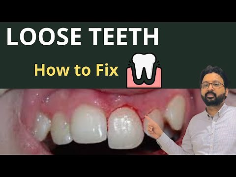 Why Your Teeth Feel LOOSE & How to Treat TOOTH Mobility