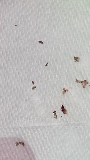 Lice Popping ASMR Videos for Relaxation and Education