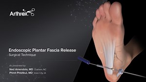 Endoscopic Plantar Fascia Release