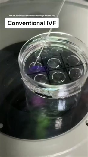 🔬 A look inside the miracle of conventional IVF! Witnessing the precise moment of fertilization under the microscope is truly breathtaking. In Conventional IVF, washed sperm are introduced to the egg in a culture dish, allowing one sperm to fertilize the egg naturally. Science meets nature in the embryology lab. #IVF #ConventionalIVF #Embryology #FertilityJourney #UnderTheMicroscope #ScienceOfLife #TTC 📹: Unknown | Fertility Specialists Medical Group