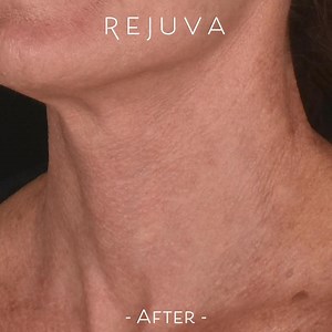 Halo and BBL Laser Combination Treatment