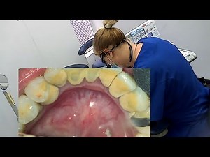 Dental visit / Teeth cleaning / Scaling