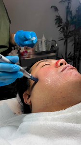 6.1K views · 23 reactions | During a vampire facial, blood is extracted and separated in a centrifuge so that the plasma can be concentrated. Then, it’s injected back into the skin to promote new collagen growth and reduce the signs of age. #AlagangInchang #AlagangInchangAngelesBranch #aesthetic | Vavaing Kapampangan | Facebook