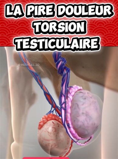 #medecine #operation #chirurgie #apprendre C'est la pire douleur pour un homme !! La torsion testiculaire n'est pas une torsion du testicule lui-même, mais une rotation du cordon spermatique qui contient les vaisseaux sanguins. ​Ce mouvement coupe brutalement l'arrivée de sang (l'ischémie), ce qui peut entraîner la nécrose du testicule en seulement 6 heures. ​L'opération, appelée scrototomie d'exploration, commence par une incision rapide sur le scrotum sous anesthésie générale. ​Le chirurgien a