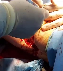 Above Knee Amputation