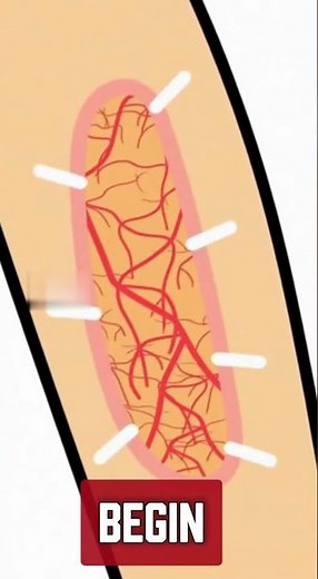 How Stitches Work #HowStitchesWork #MedicalScience #WoundCare