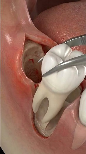 Impacted Wisdom Tooth Removal 🦷 | 3D Extraction Animation (Step-by-Step)