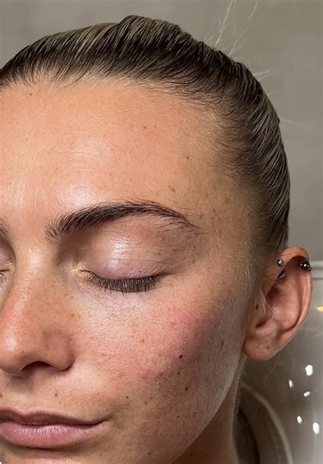 Tear Trough Filler Results That Speak Volumes