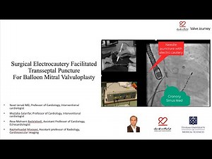 Surgical Electrocautery Facilitated Transseptal Percutaneous mitral balloon commissurotomy (PMBC)