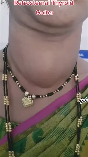 A substernal goiter, also known as a retrosternal goiter, is an enlarged thyroid gland that grows inferiorly and passes through the thoracic inlet into the thoracic cavity. A substernal goiter is generally defined as a thyroid mass that has 50% or more of its volume located below the thoracic inlet.