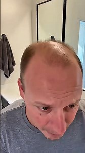 Curing Baldness In 2099 🤔