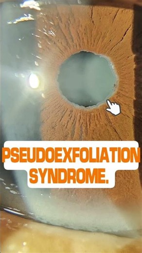 This Flaky Deposit Can Blind You — Pseudoexfoliation Explained #ophthalmology