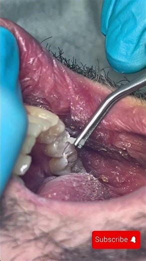 Satisfying Dental ASMR | Fiber Post Cutting