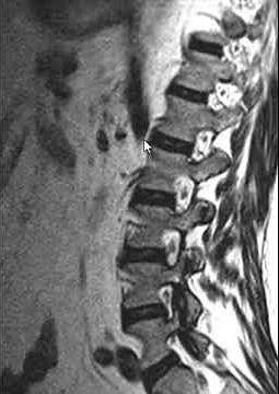 Median arcuate ligament syndrome