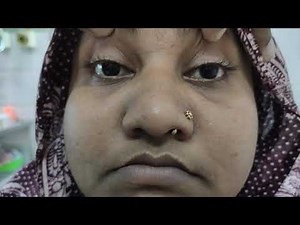 Relative Afferent Pupillary Defect (RAPD)