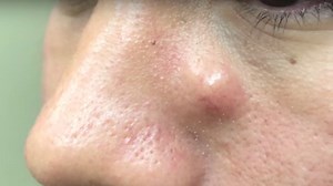 Watch Dr. Pimple Popper YANK a Stubborn Growth From This Man’s Nose