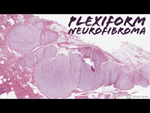 Plexiform Neurofibroma in Neurofibromatosis-1 NF1: 5-Minute Pathology Pearls