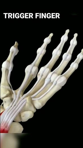 Trigger Finger#triggerfinger #triggers #handanatomy #physicaltherapy #movement #anatomy #shorts