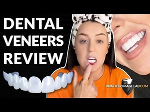 Snap On Veneer Review: Are Dental Veneers Worth It?