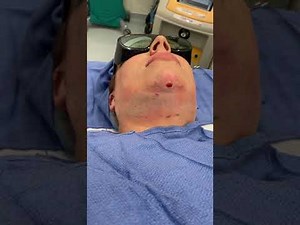 Smartlipo laser treatment and liposuction to chin - video includes fat aspiration