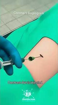 Coronary Angiography (CAG) Explained | Procedure, Indications & Findings