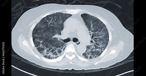 CT Chest or CT Lung axial mip view showing lung after infected covid-19 .