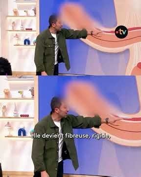 What is Peyronie's disease (curved penis)?