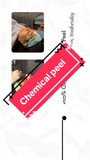 Chemical Peel Camp for Clearer Skin