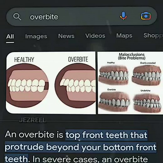 Dealing with Insecurities: Overcoming an Overbite