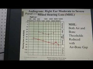 Pure Tone Audiogram Part 1 - Interpretation - Dr Mohan Bansal