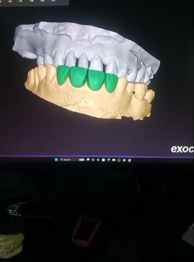 🦷 Incisor Case Design in Exocad | Step-by-Step Digital Workflow