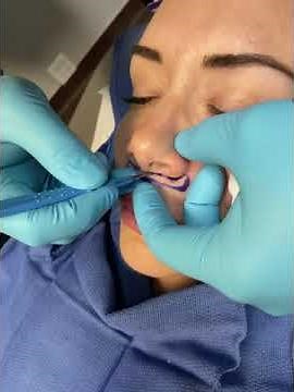 Lip Lift - Step by Step