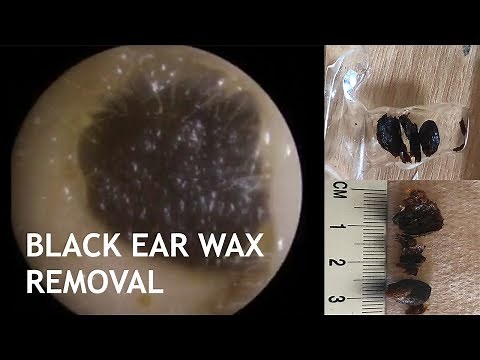 BLACK EAR WAX REMOVAL - #437