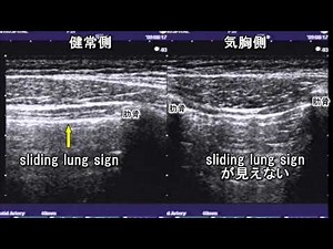 気胸のエコー像