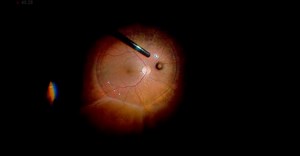 Post-Pneumatic Retinopexy Retinal Detachment With PVR - Eyetube
