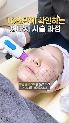 10초만에 확인하는 써마지 시술 과정 & 전후 ✨