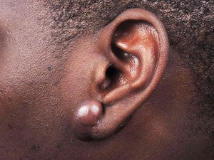 Why You Should Not Use Rubber Bands To Remove Keloid Scars
