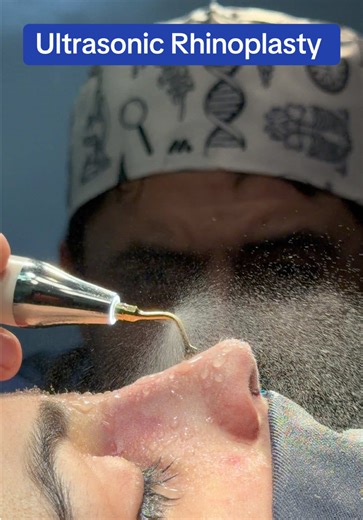 Transform Your Profile with Ultrasonic Rhinoplasty