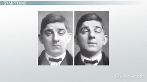 What is Ptosis? - Definition, Causes, Symptoms & Treatment