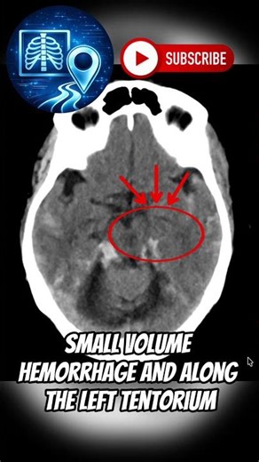 There’s Blood on This CT… But Most People Stop Too Early #radiology #shorts