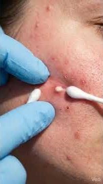 Severe Acne Burst Cleanup | Satisfying Pimple Removal Transformation 🤯 #shorts #skin #skincare