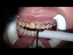 Gingivectomy in aesthetic zone, Gummy smile treatment. Cosmetic Dentistry Los Angeles 818.776.0055