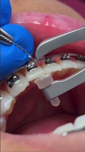How to fully engage a TMA wire on a rotated tooth with the help if a band remover and steel tie