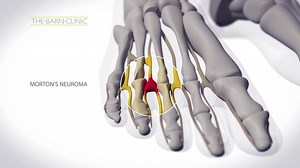 A super simple explanation of the Cryosurgery treatment for Morton's Neuroma! If you have any questions, just drop us a message, email or give us a call so we can discuss the treatment with you! www.mortonsneuroma.co.uk - 0114 221 4780 - info@thebarnclinic.co.uk | Morton's Neuroma