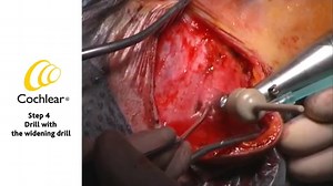 Baha Attract Surgical Video