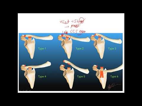 ROCKWOOD CLASSIFICATION FOR ACROMIOCLAVICULAR JOINT DISLOCATION