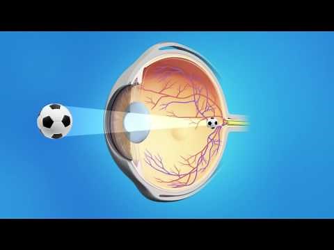 All-Laser LASIK