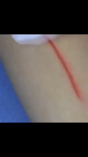 Latest Medical News on Instagram: "Steri-Strips and similar wound closure strips work by helping the two ends of a wound come together. This helps with healing and prevents infection. You might have Steri-Strips in your medicine cabinet or first-aid kit. Have you ever used them? #woundcare #suture #emergency #breakthrough #skin"