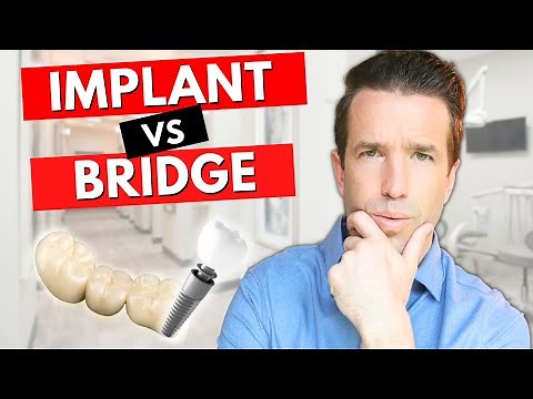 Dental Implants vs Bridges for a Missing Tooth
